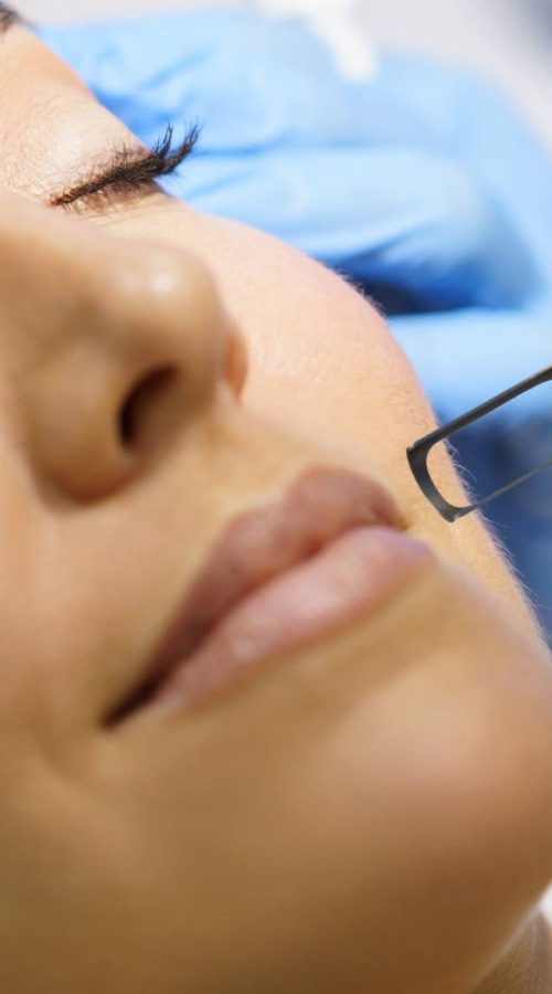 removal-mataro-Micropigmentacion10